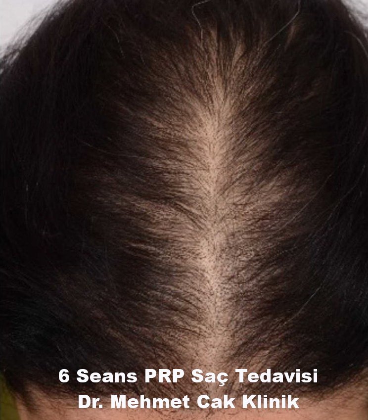 Prp Saç Tedavisi Prp Saç Tedavisi